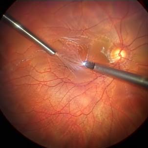 Cirurgias Vitreorretinianas