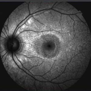 Autofluorescência da Retina