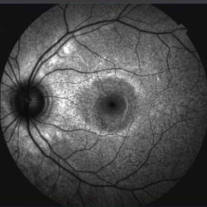 Autofluorescência da Retina