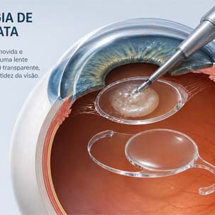 Cirurgia de catarata