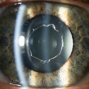 Capsulotomia posterior com YAG laser