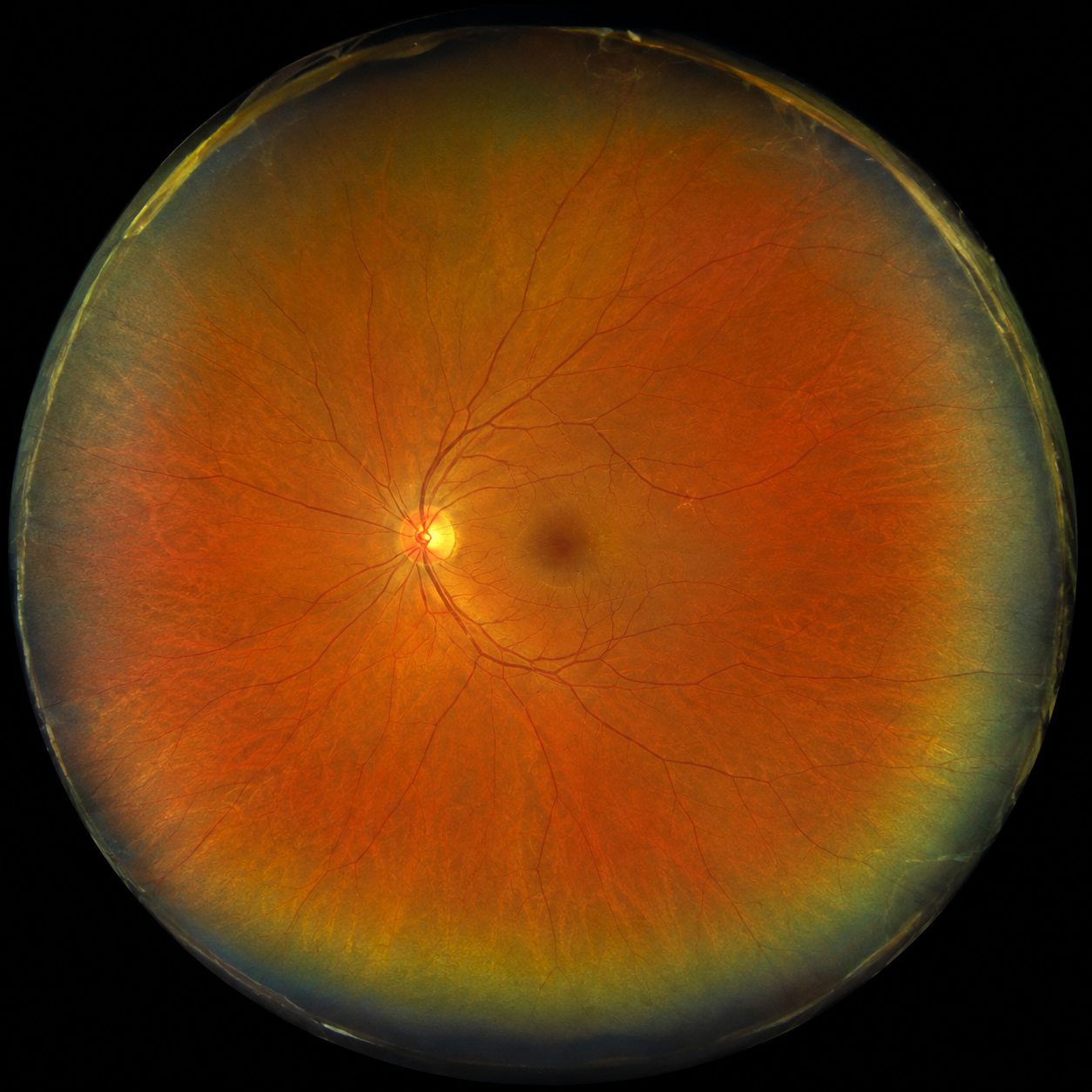 Retinografia de grande angular