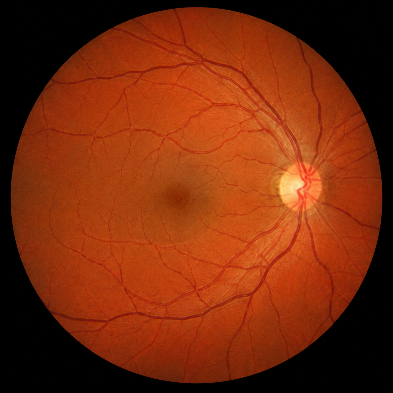 Retinografia colorida